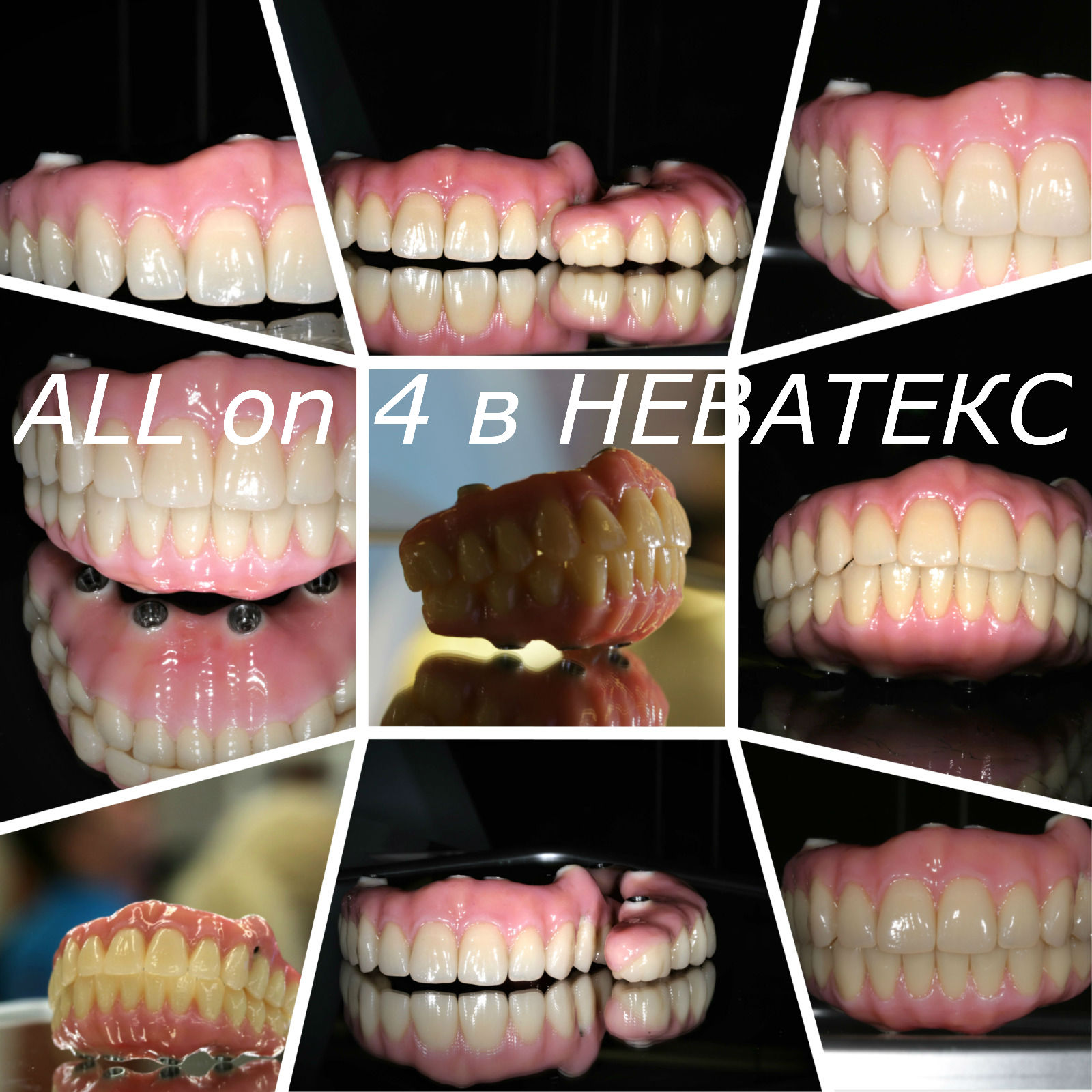 all on 4 в клинике неватекс all on 4 в неватекс